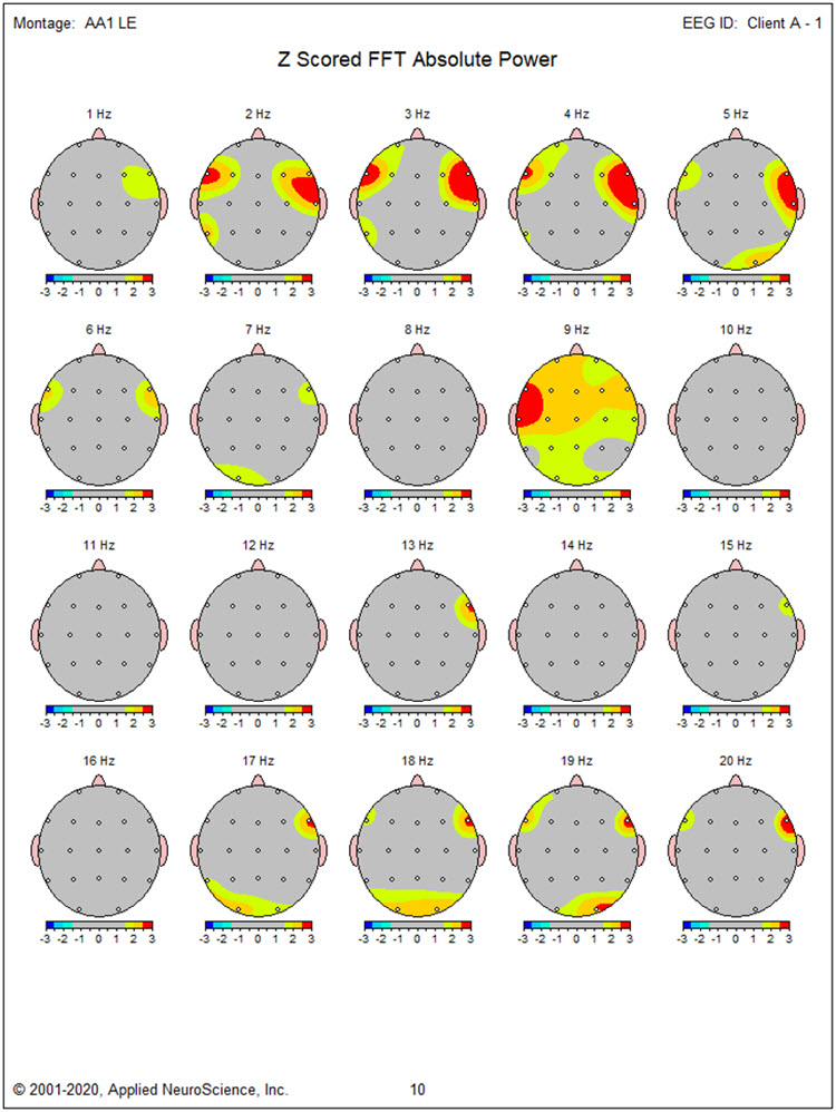 Z-scored FFT absolute power linked ears montage showing bilateral slow activity